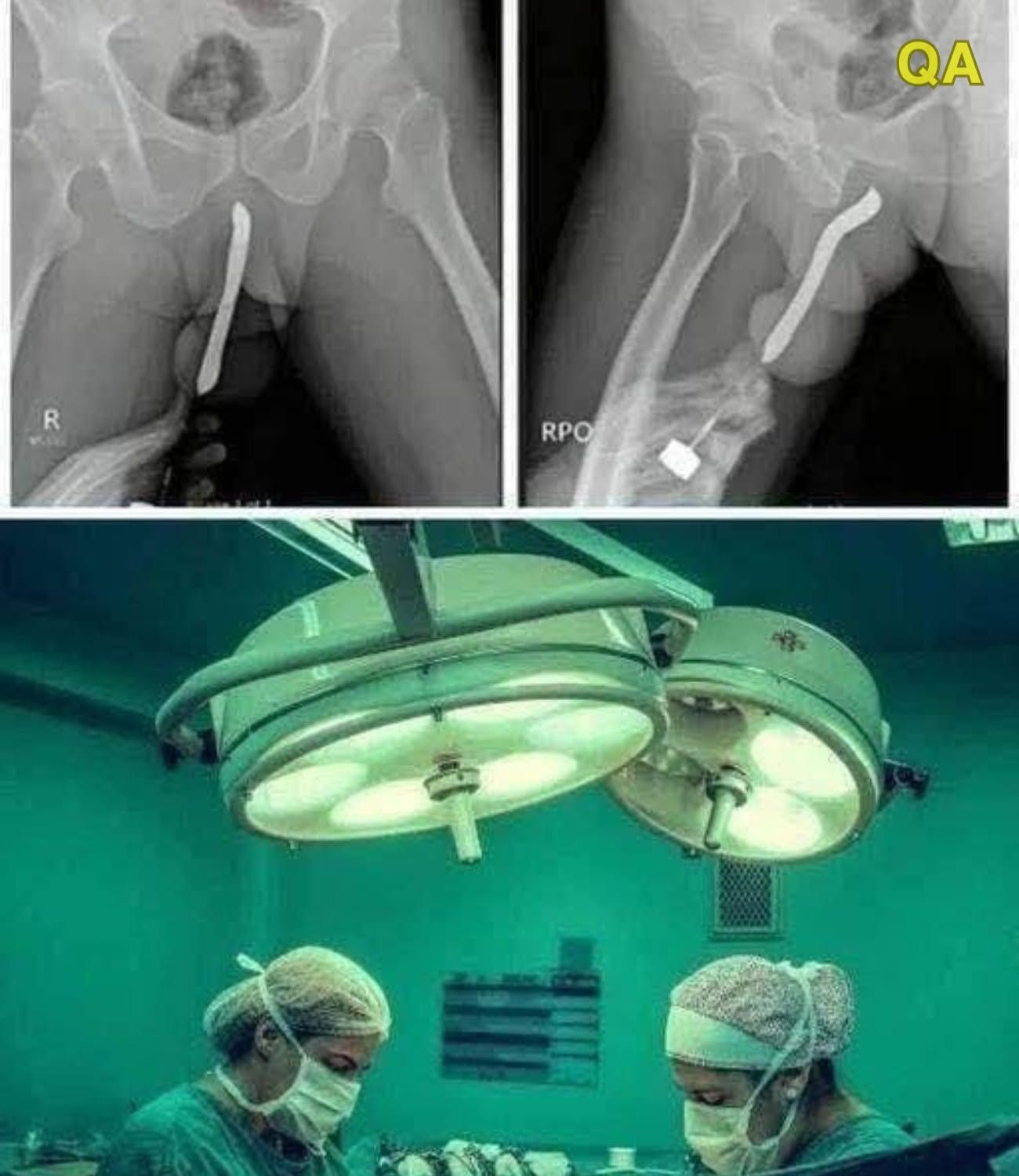 HT14. Young woman was hospitalized after being pene…
