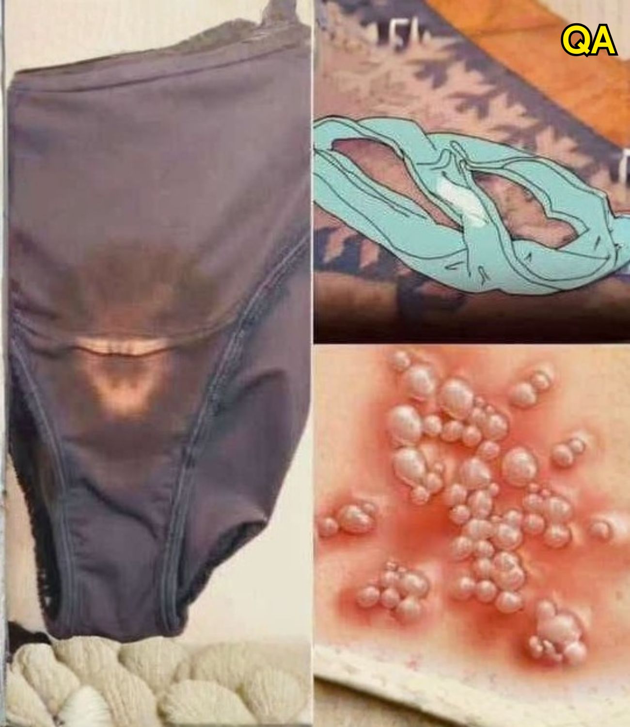 HT14. Why You May Notice Bleach-Like Stains on Your Underwear: Causes, Concerns, and When to See a Doctor