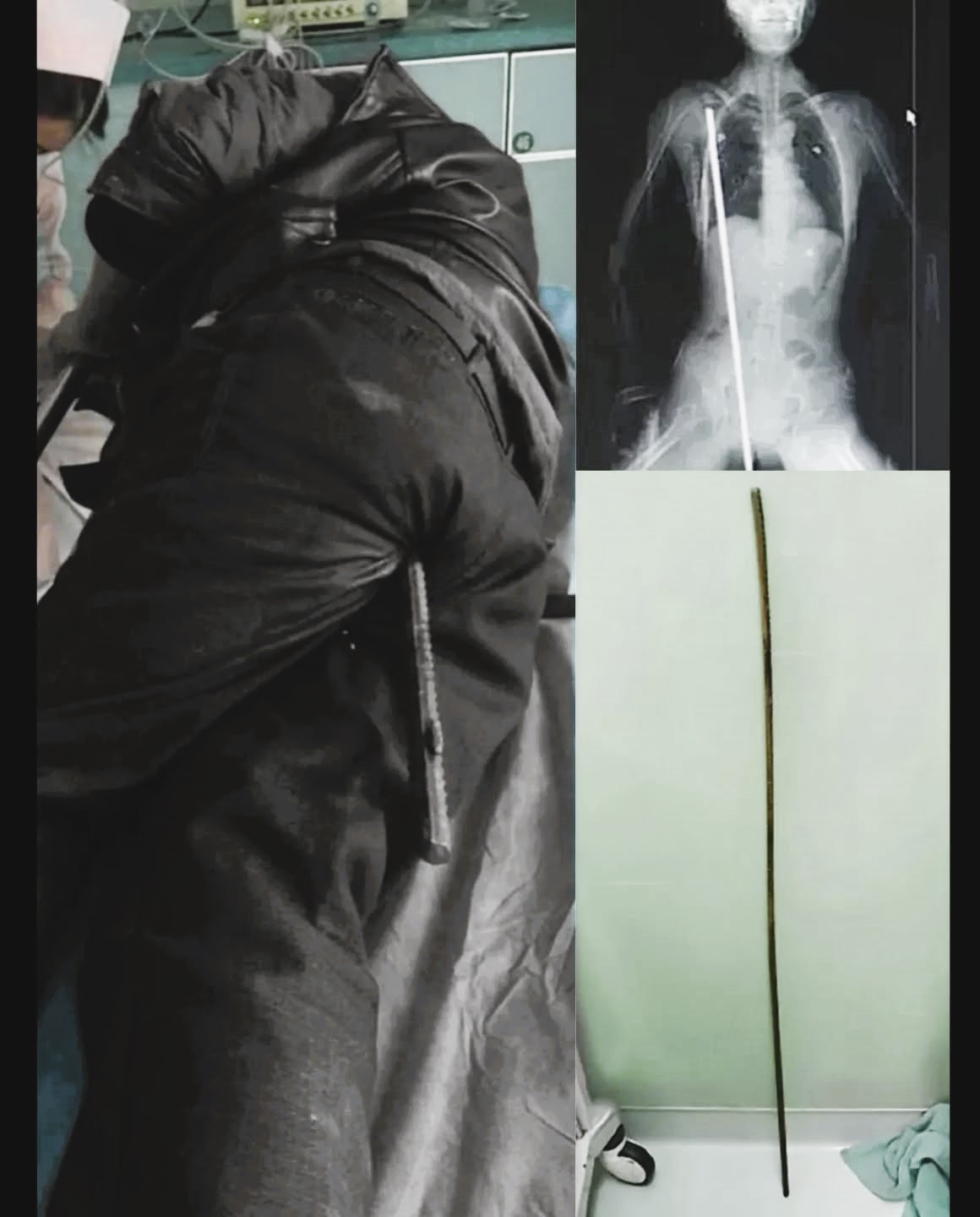 HT1. Construction Worker Survives After Being Impaled by 24-Inch Metal Rod