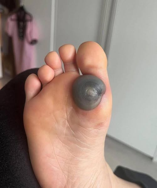 HT1. My daughter woke up with this huge spot on her foot I don’t know what it could be.