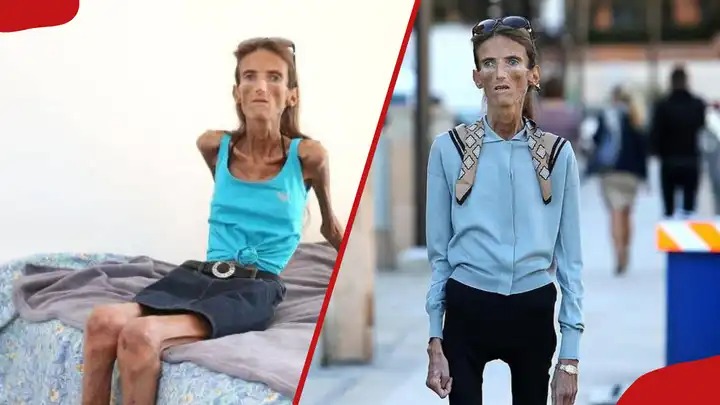 ST10. World’s Thinnest Woman Receives Fan Mail to Be Like Her
