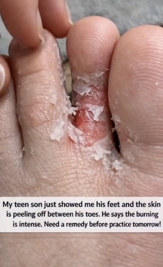 HT1. My teen son just showed me his feet and the skin is peeling off between his toes