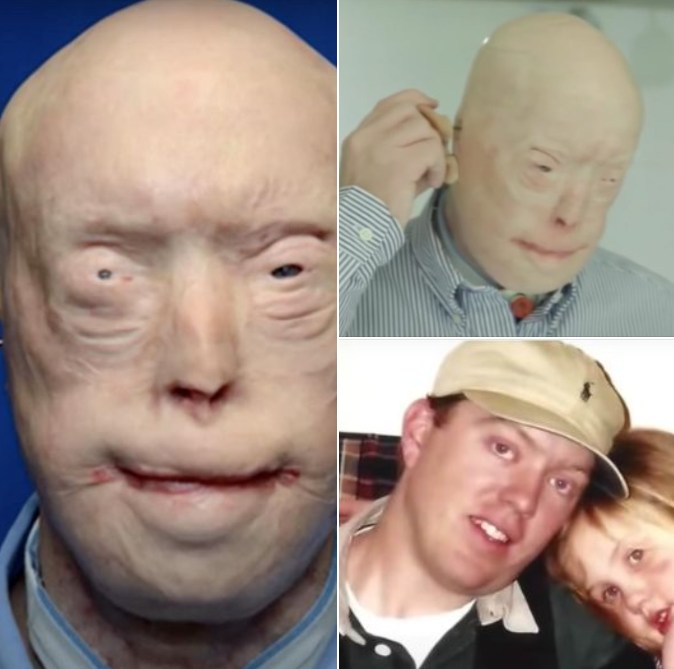 HT10. Brave firefighter has face transplant after suffering third-degree burns, & survives against all odds