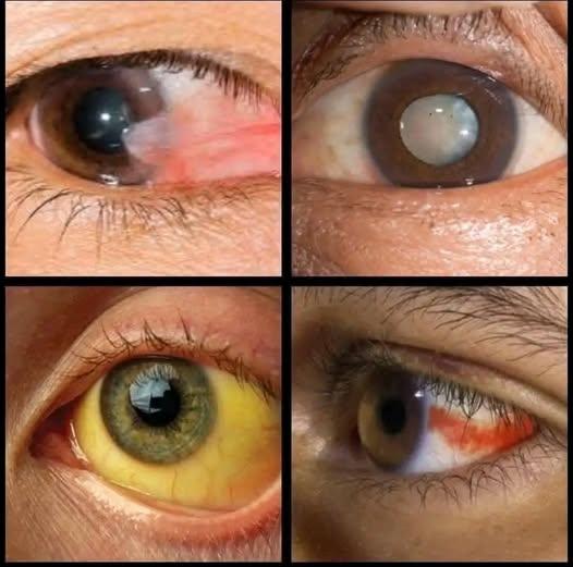 HT10. These Common Eye Changes Could Mean More Than You Think
