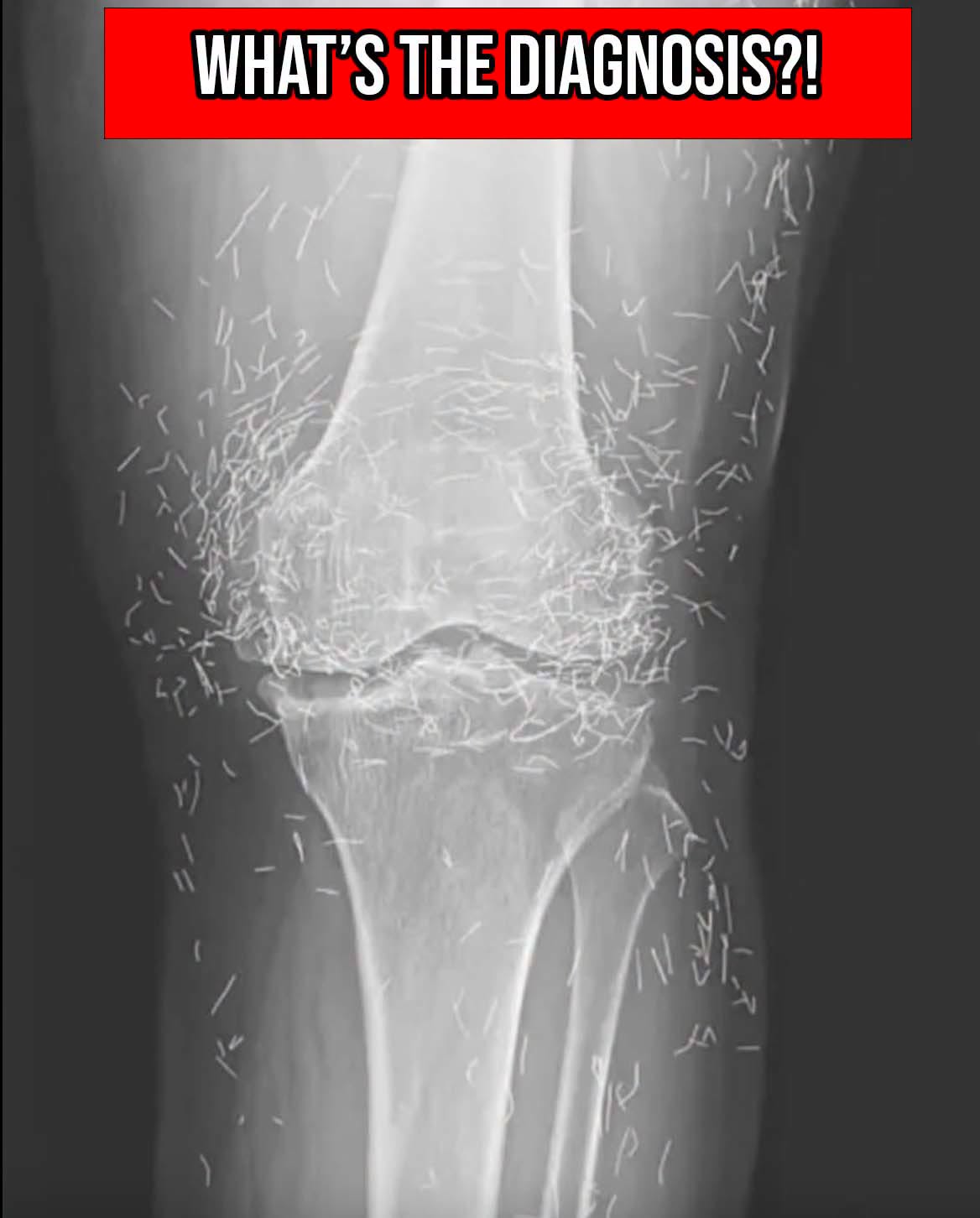 HT10. A 65-year-old woman went in for knee pain, leaving doctors in disbelief after X-ray revelation