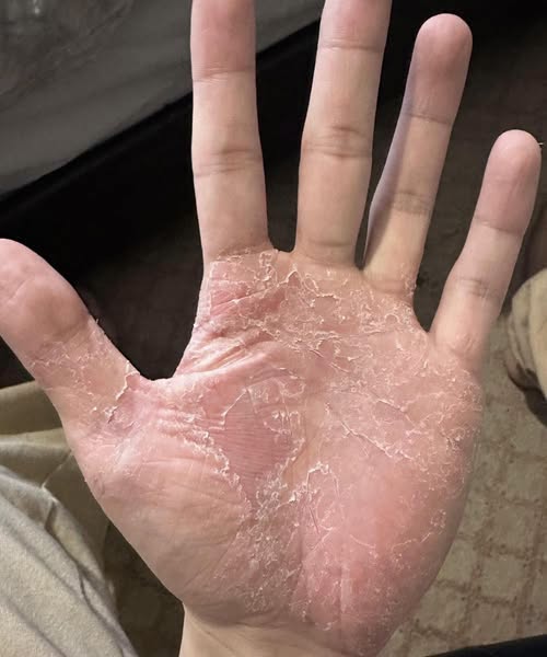 HT6. What Changes in Your Hands Could Be Telling You About Your Skin Health