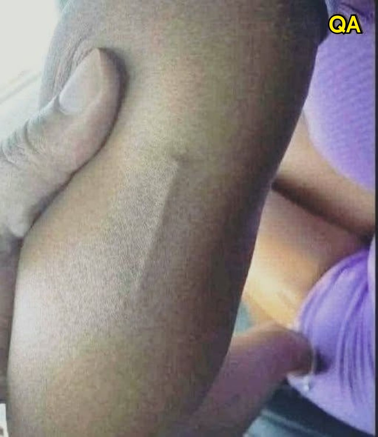 HT14. Something Appeared on My Daughter’s Arm and I Had No Idea What It Was
