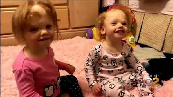 ST4. Doctors Said These Conjoined Twins Had Almost No Chance of Survival—Now They’re Celebrating an Incredible Milestone