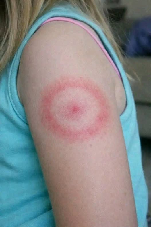 HT6. The Red Ring of Terror: Is Your Child’s Mysterious Rash a Harmless Bug Bite or a Life-Changing Diagnosis?