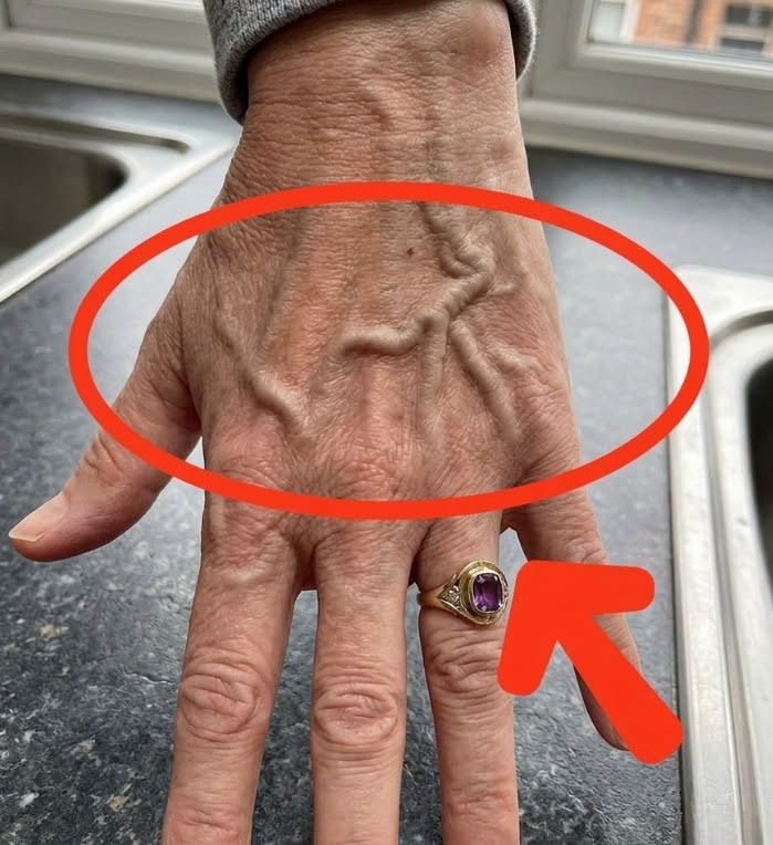 HT3. What Bulging Veins Can Mean