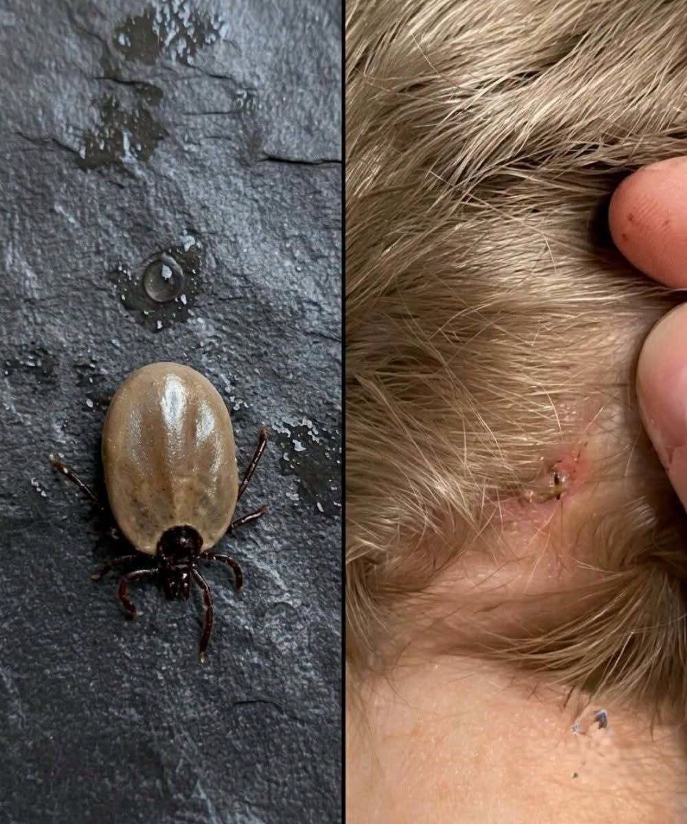 HT1. You Are Likely Ignoring The Deadly Warning Signs Of A Tick Bite That Could Ruin Your Life