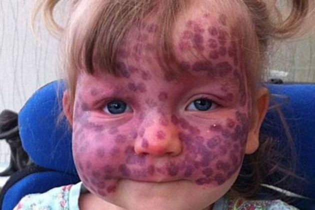 ST4. Parents respond to strangers who jump to hurtful conclusions because of their daughter’s rare skin disease