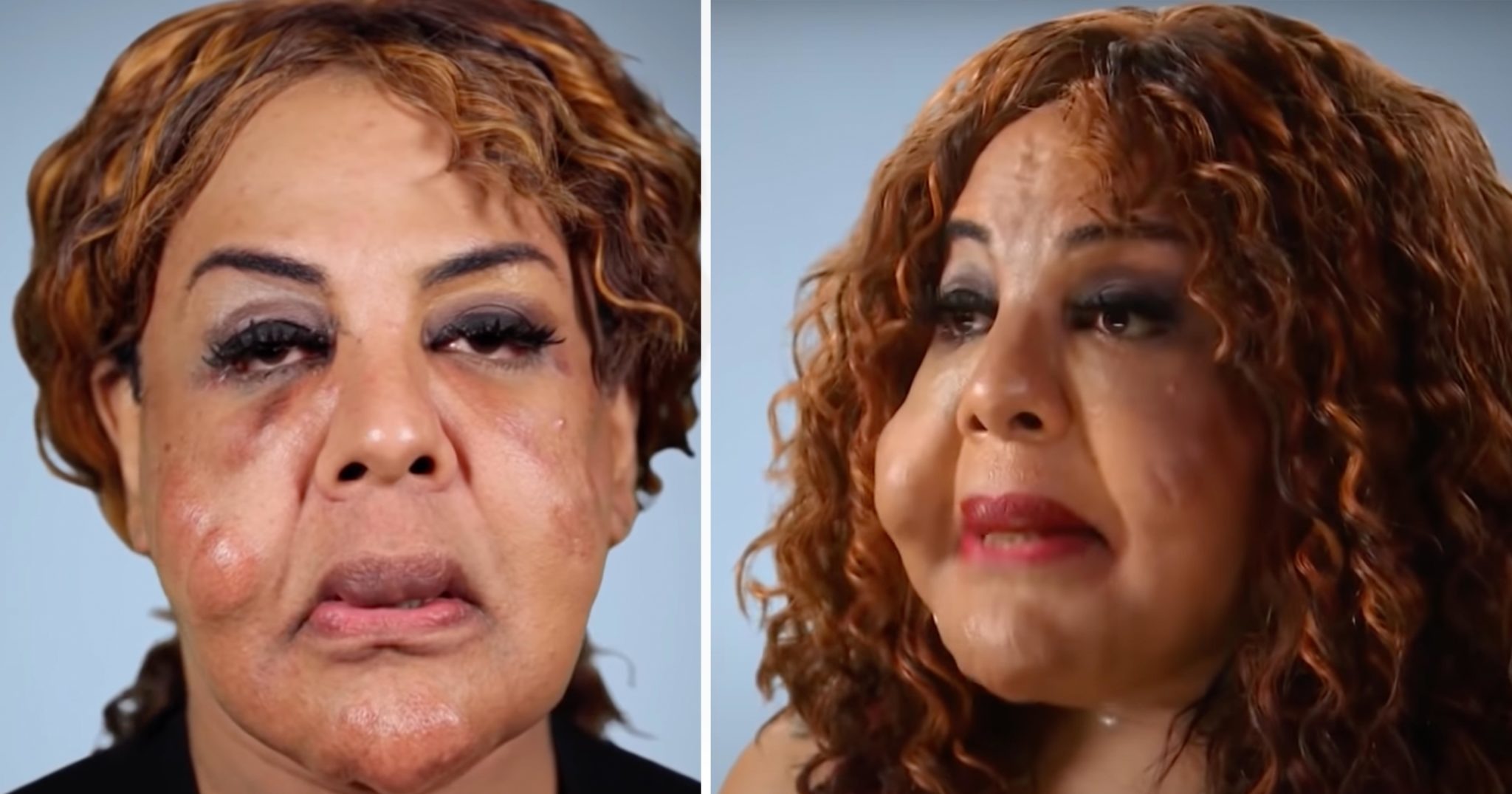 ST4. Evil “doctor” pumped her face full of cement – this is what she looks like 21 years later