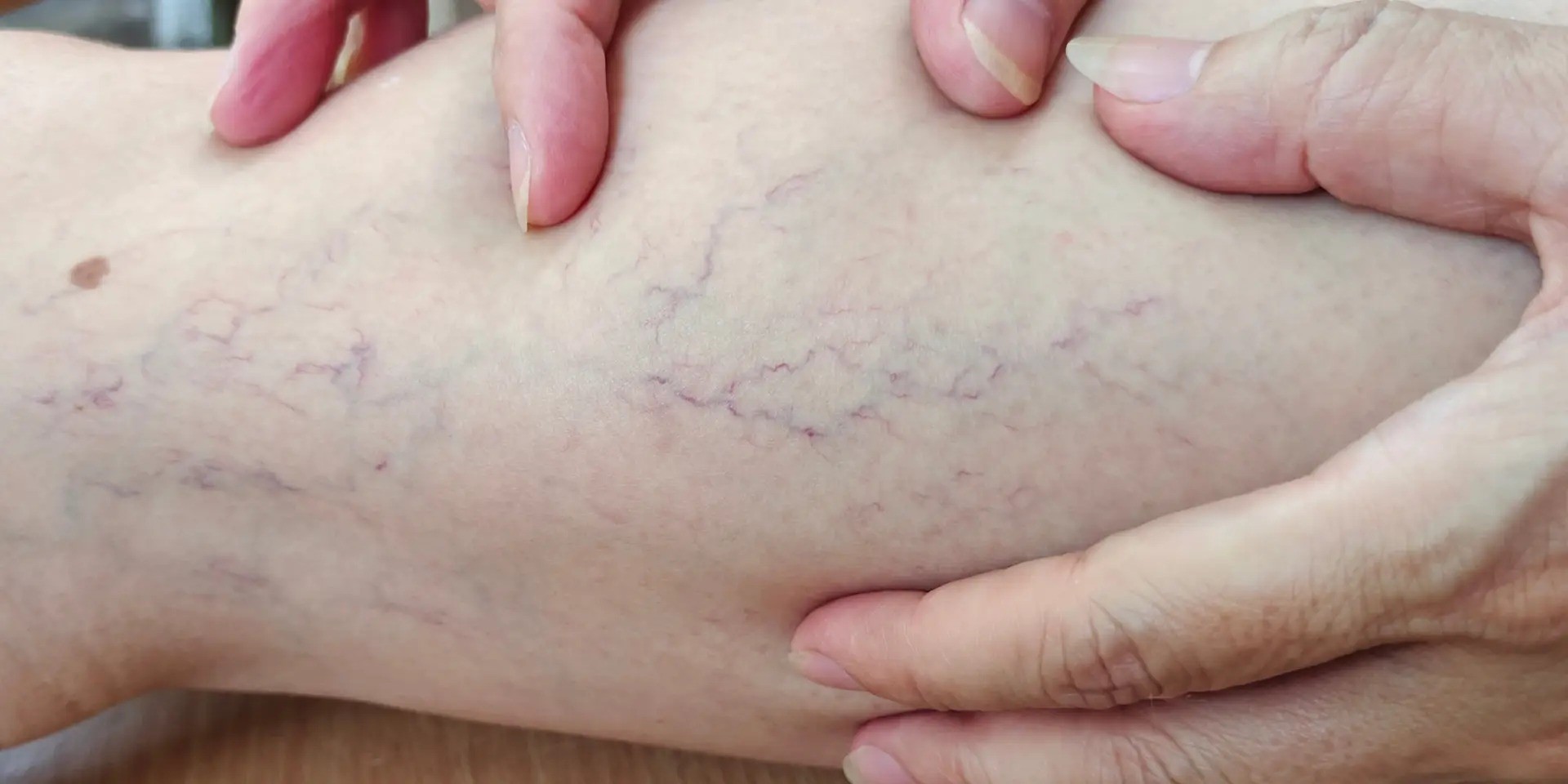 HT1. If you have purple veins on your legs, it means you are…