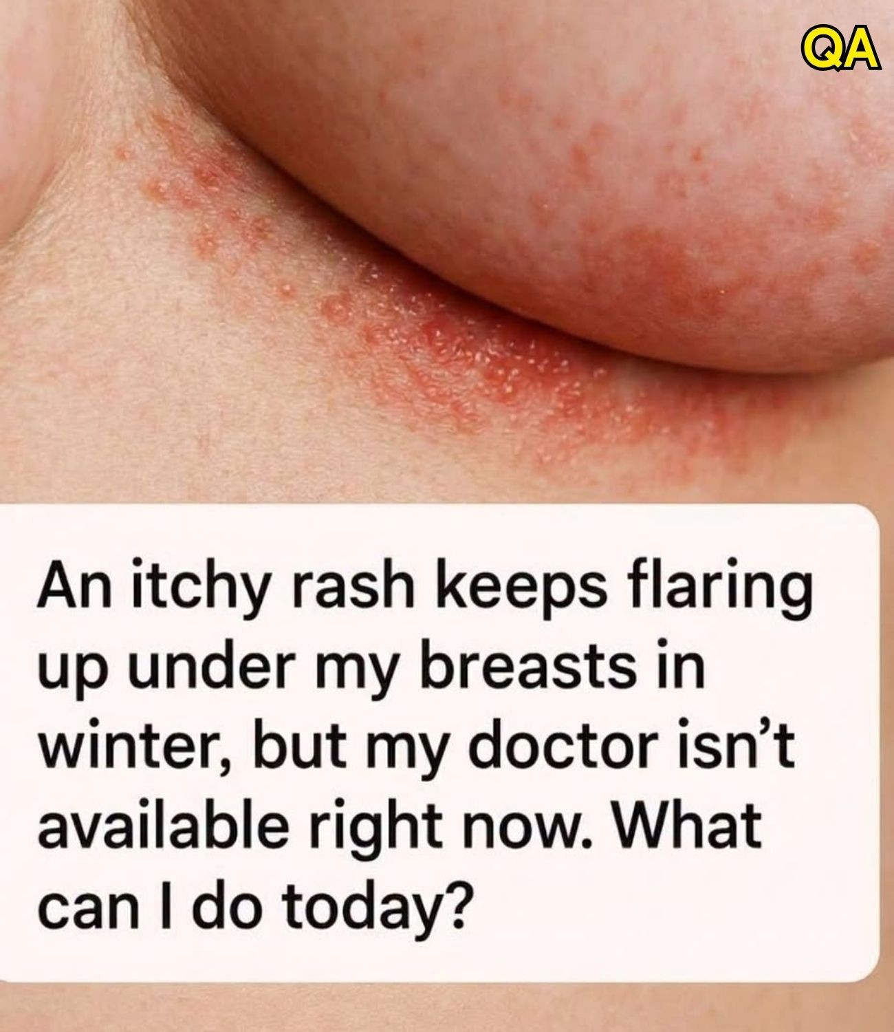 HT1. An itchy rash keeps flaring up under my breasts in winter, but my doctor isn’t available right now. What can I do today?