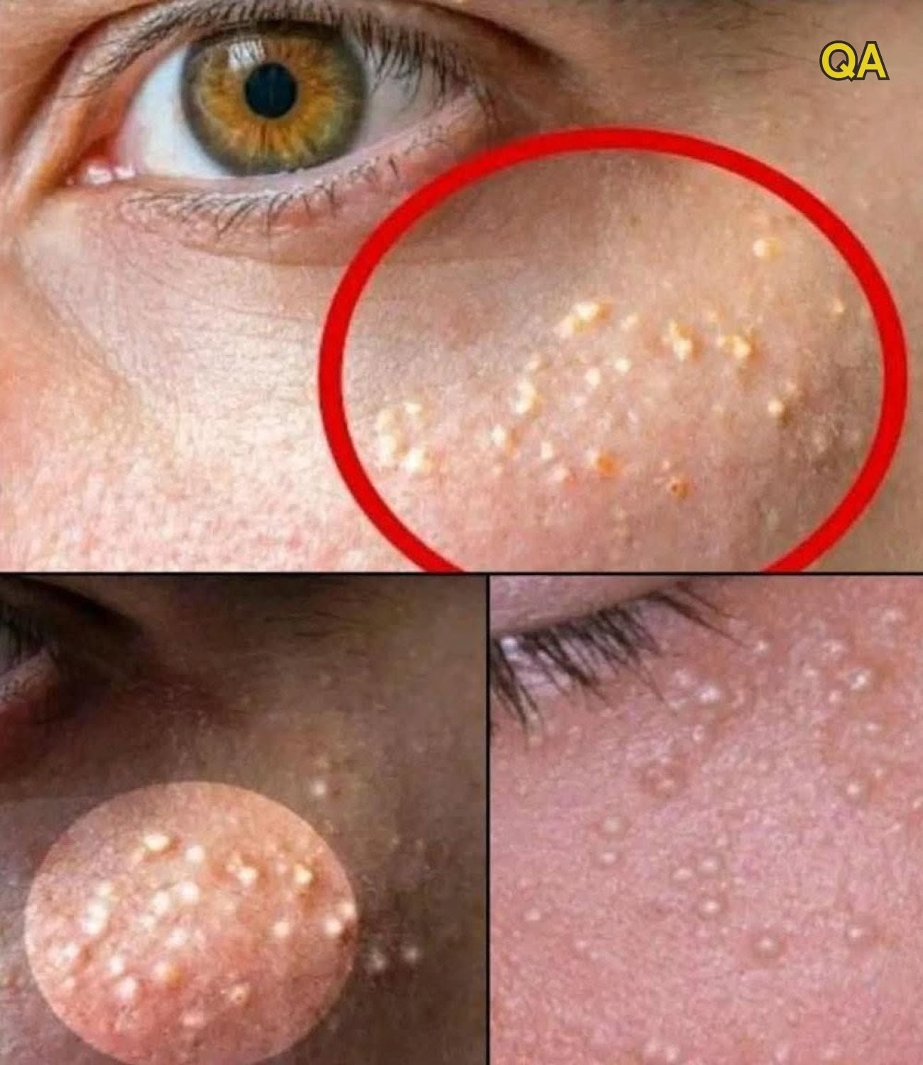 HT1. What Those Tiny White Bumps on Your Skin Really Mean