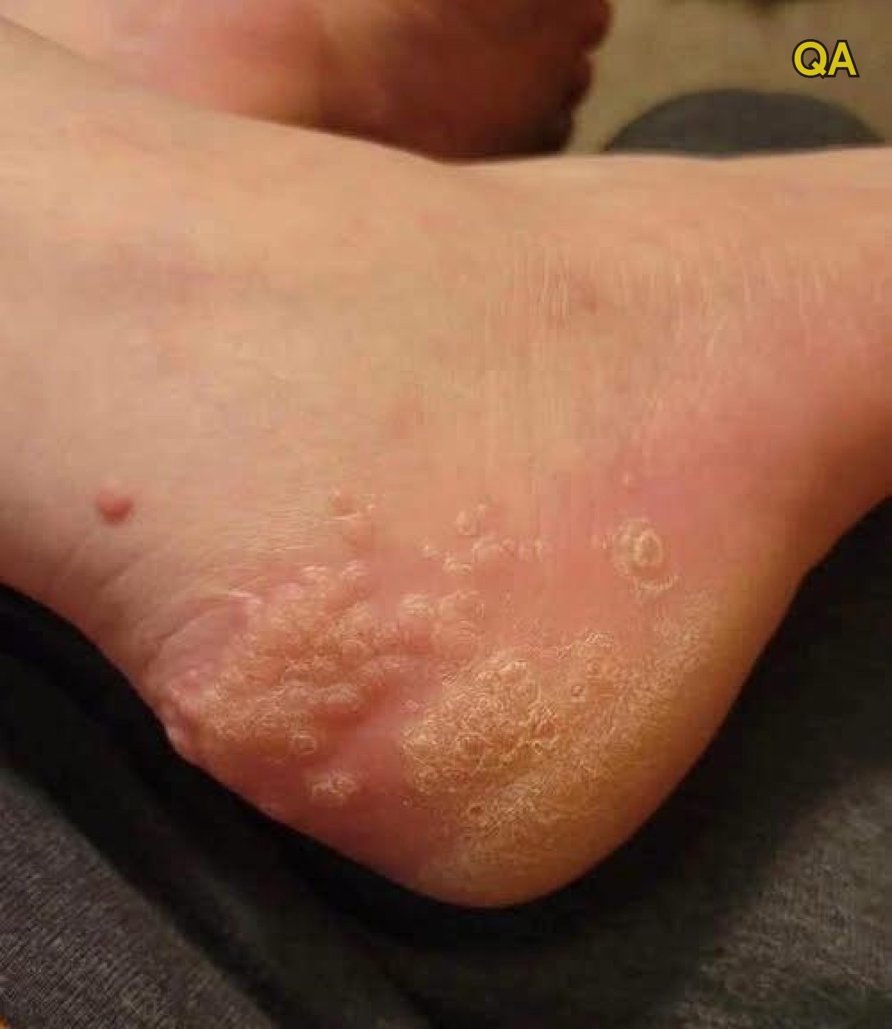 HT1. These are the consequences of wearing used… –