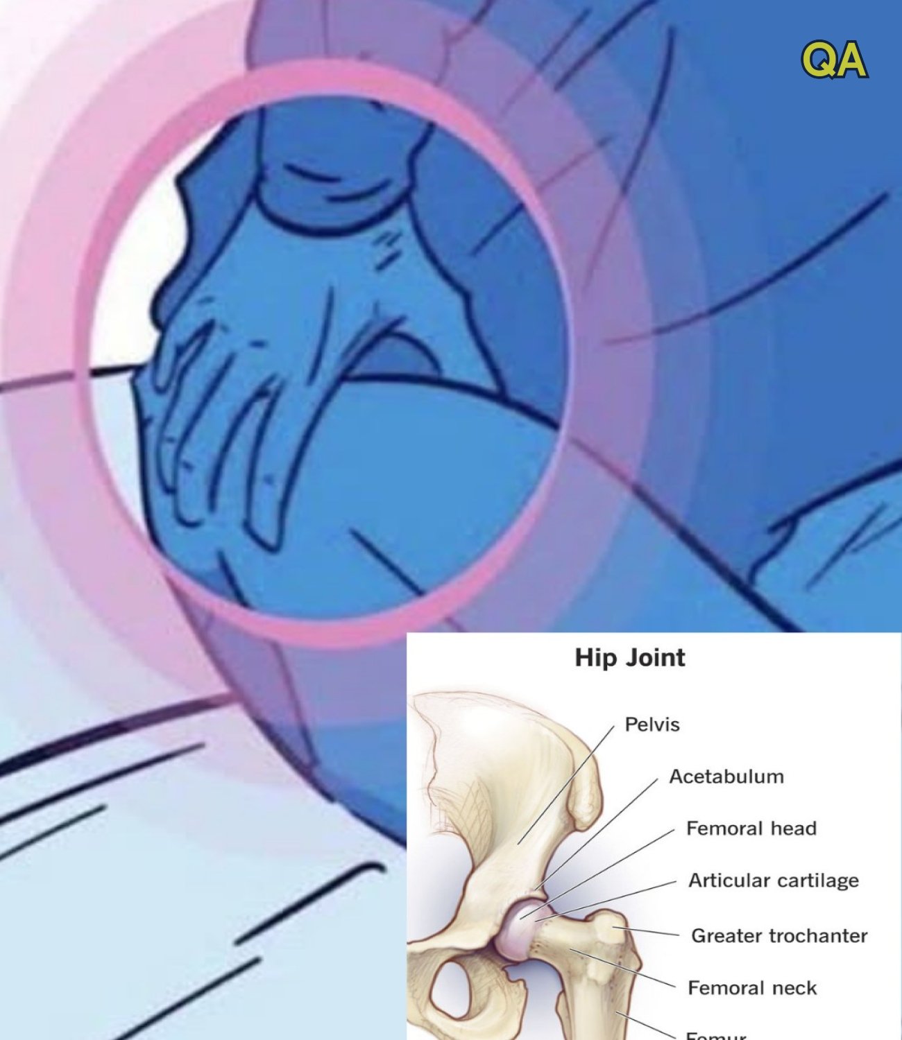 HT1. Here Is What That Squeaking Hip Might Be Telling You