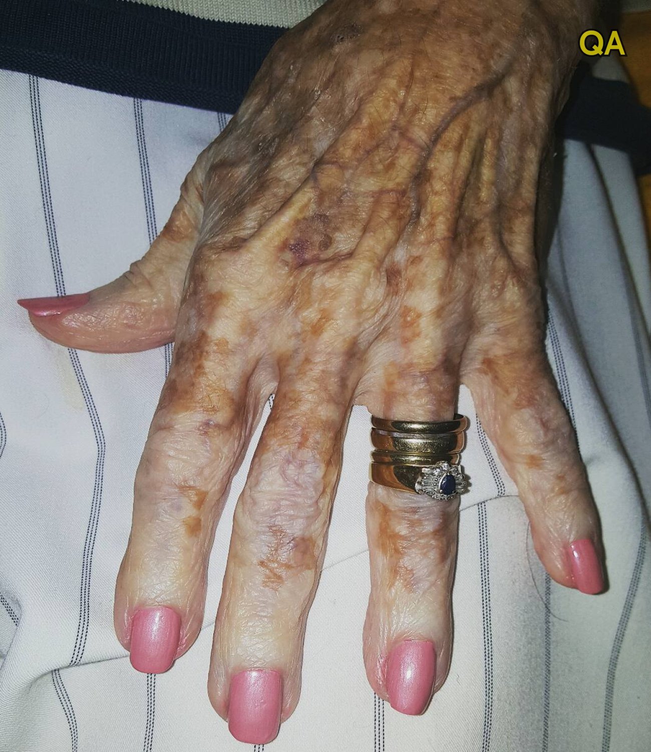 HT1. Nurse sparks internet reaction with photo of old lady’s hand