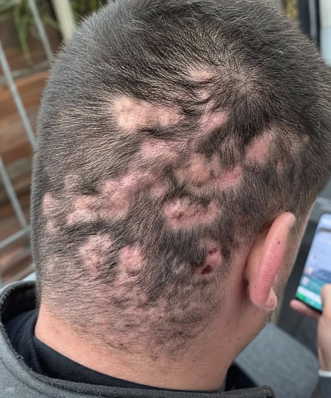 HT1. What Could Cause Inflamed Bumps, Hair Loss and Scarring?