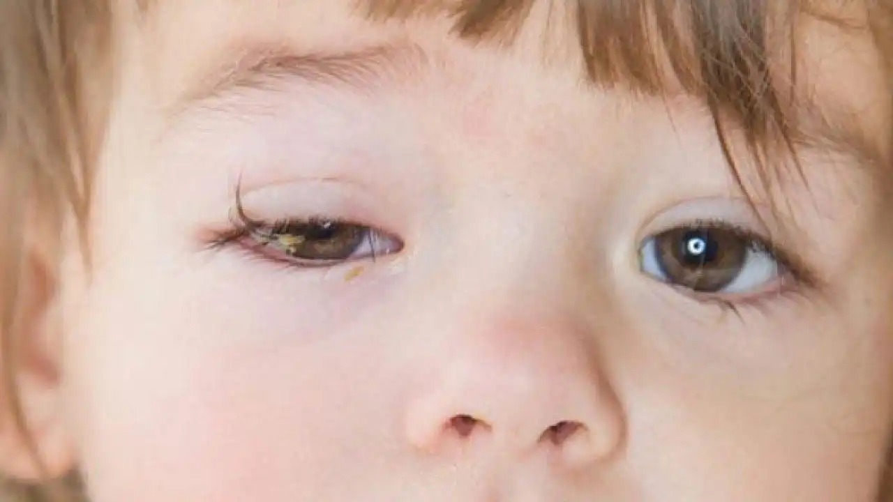 HT1. Understanding Eye Infections: Causes, Symptoms, and Effective Treatments