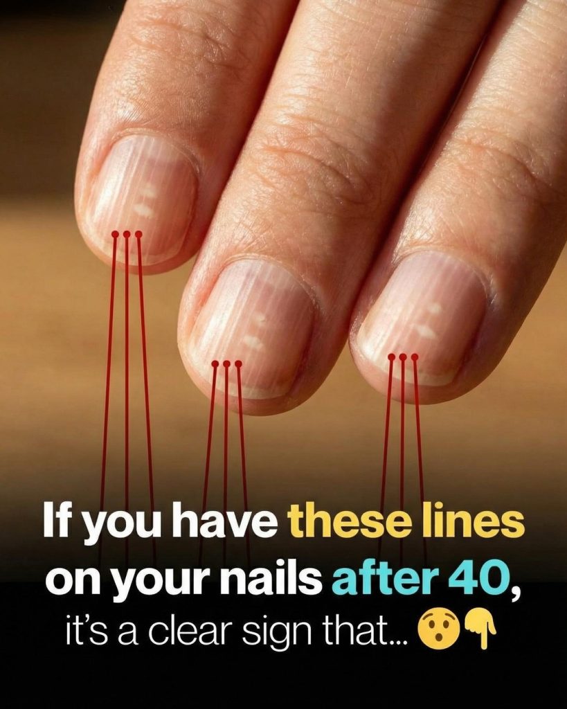 HT3. Why Vertical Lines on Your Nails Often Appear With Age