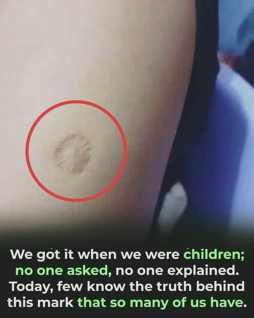 HT1. A Small Mark From Our Childhood Holds A Story Many People Never Learned See More