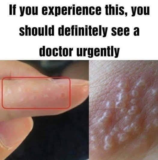 HT1. If You See These Painful Red Bumps You May Have Dyshidrotic Eczema 2