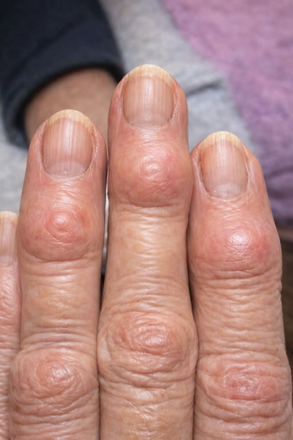 HT1. The Terrifying Truth Behind the Mysterious Hard Bumps Spreading Across Your Hands