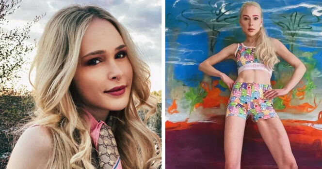 HT4. Model pays $165,000 to extend her legs by 5.5 inches – just look at her today now she has “huge regrets”