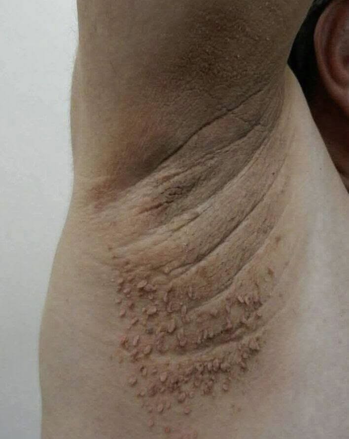 HT1. The Shocking Secret Behind Dark Neck Patches: The Deadly Health Warning Hiding on Your Skin