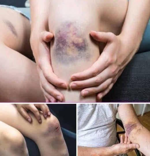 HT1. BE CAREFUL, if you get these bruises on your body, it means you have Ca…see more