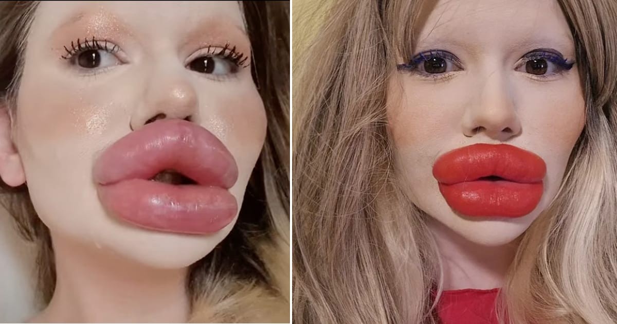 HT4. 24-year-old woman wants the biggest lips in the world