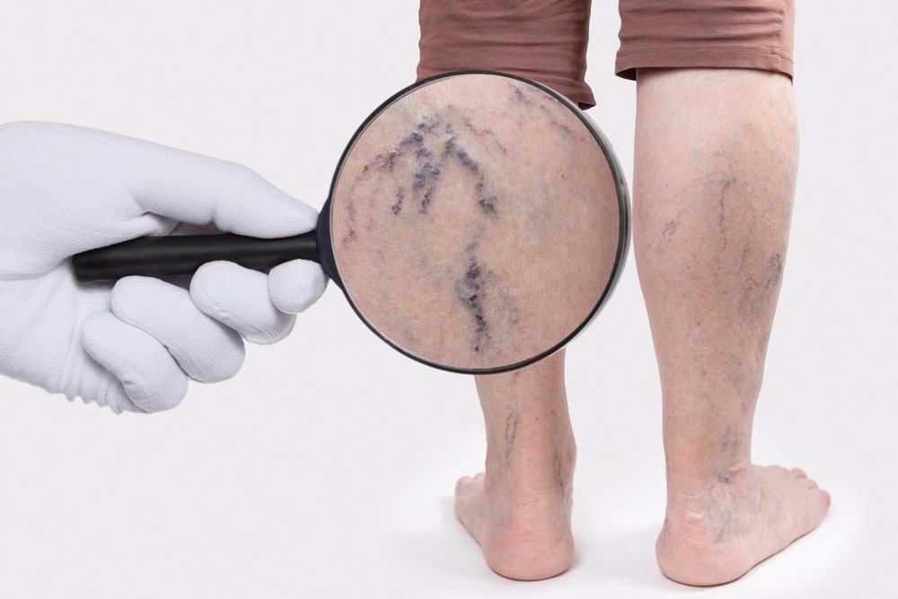 HT1. Why are your veins suddenly bulging and visible? –