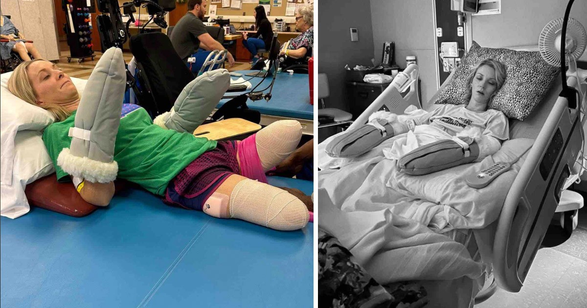 HT2. Mom woke up from routine surgery to discover all four limbs had been amputated