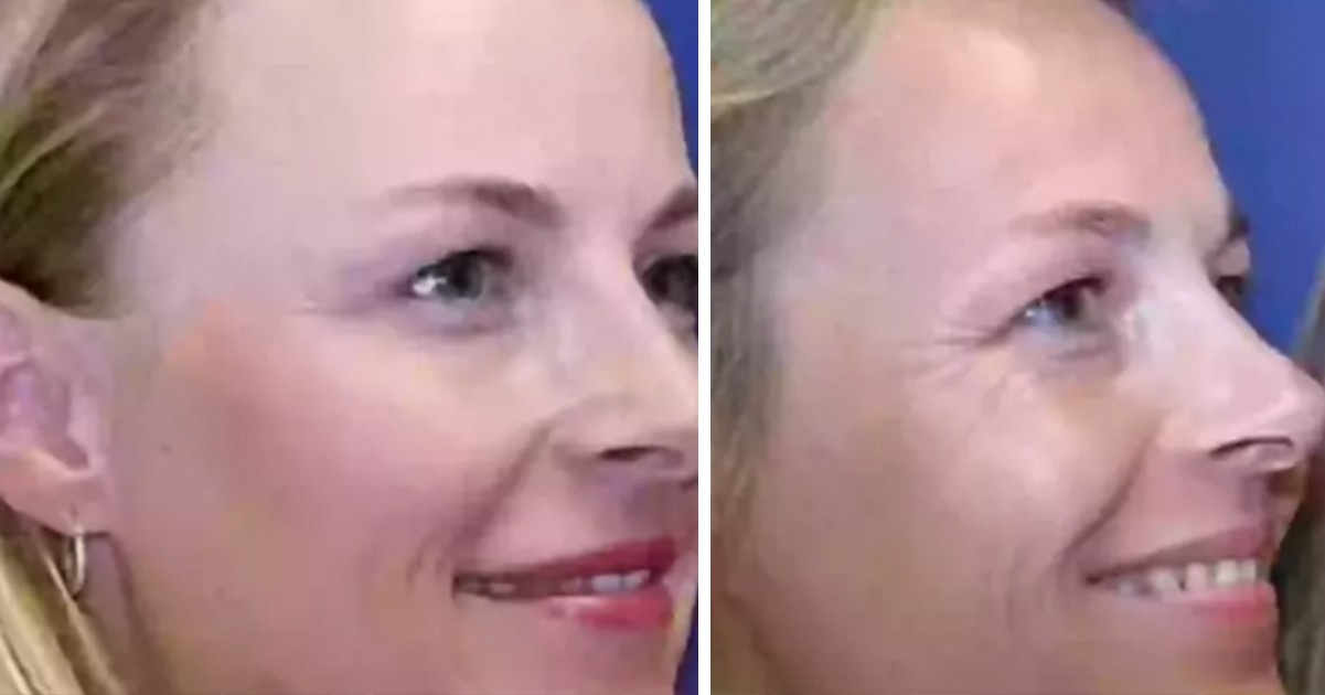 HT1. Identical twins share shock results after one used Botox for 20 years and the other didn’t
