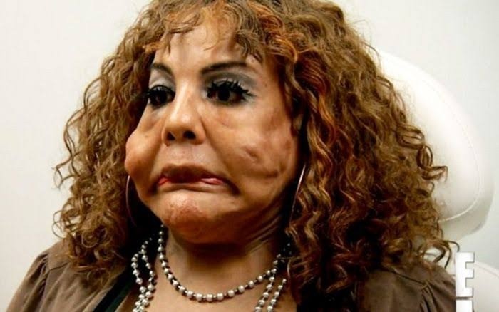 ST1. “She Was Injected With Cement — See Her Shocking Transformation 14 Years Later!”