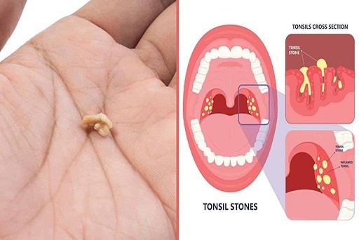 HT1. Here’s what you need to know about tonsil stones
