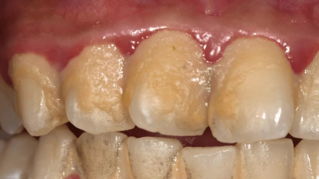 HT1. Be careful!! This is what your teeth will become when you eat…
