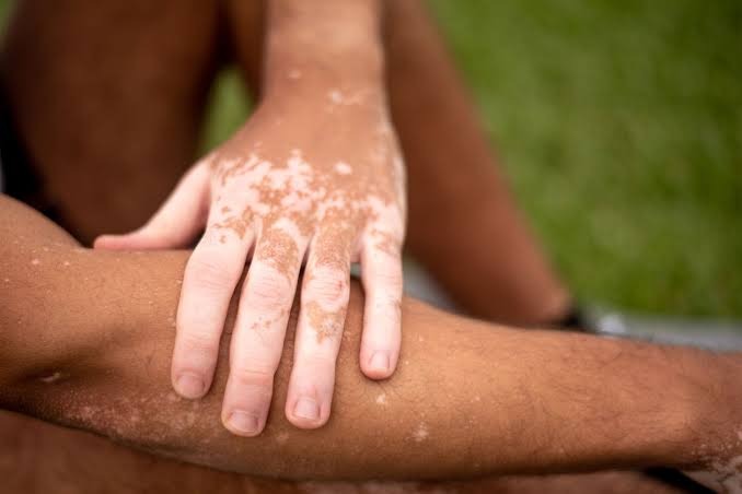 HT1. What Vitamin Deficiencies May Lead to White Spots on the Skin