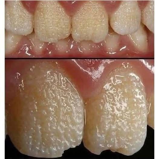 HT1. Be careful!! This is what your teeth will become when you eat…