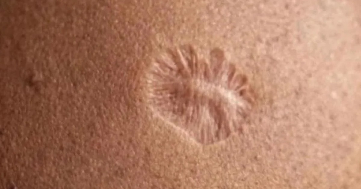 HT2. Real reason so many people have this exact same scar