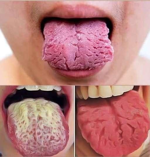 HT1. If Your Tongue Is White , this is a clear sign that you are suffering from…