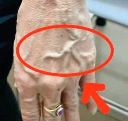 HT4. The Hidden Killer Beneath Your Skin: Why Those Bulging Veins Are a Warning You Can’t Afford to Ignore
