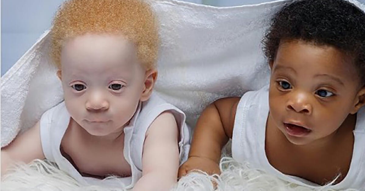 HT3. Mother gives birth to black and white twin boys