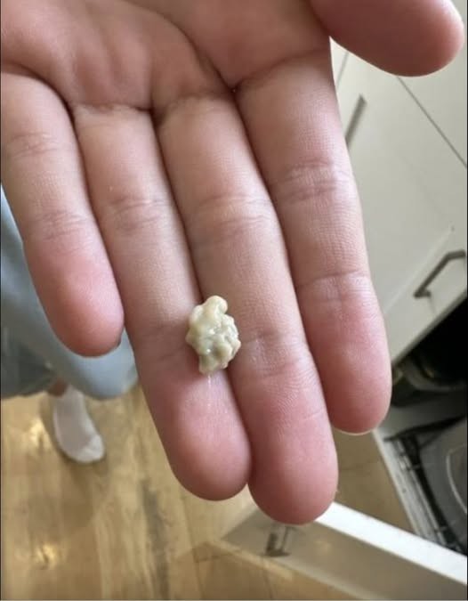 HT1. Here’s what you need to know about tonsil stones