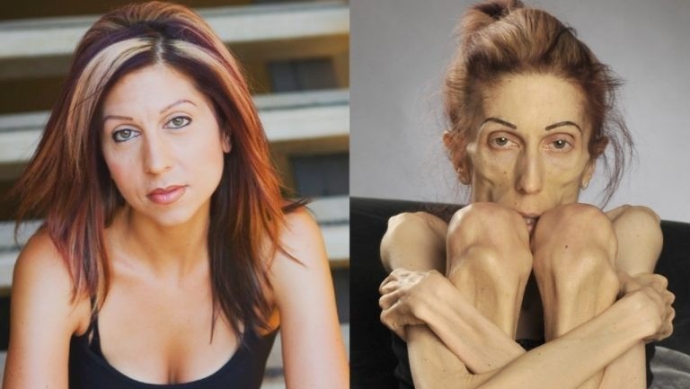 ST2. The World’s Thinnest Woman’s Battle Against Anorexia Will Leave You Speechless