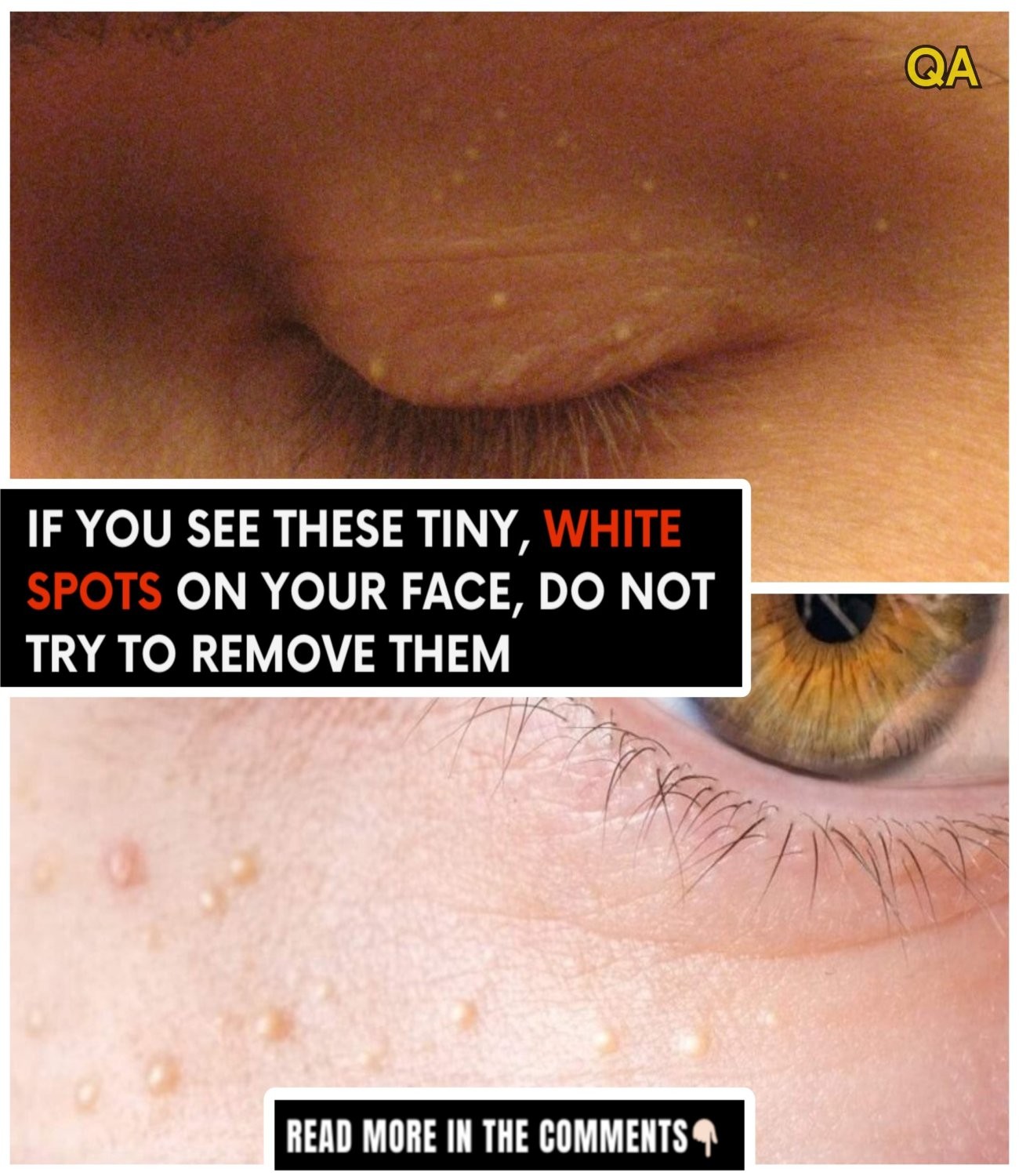 HT1. How to Safely Remove Milia