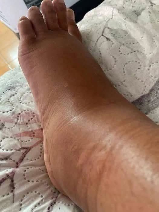 HT1. If your feet swell, it is a clear sign that…