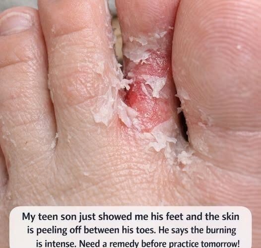 HT1. My Son’s Toes Were Burning and Peeling—What Could Be Causing It?
